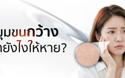 รูขุมขนกว้างควรทำหัตถการอะไร ทำอย่างไรให้หาย